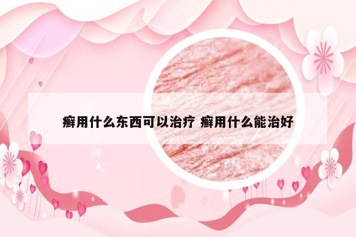 癣用什么东西可以治疗 癣用什么能治好