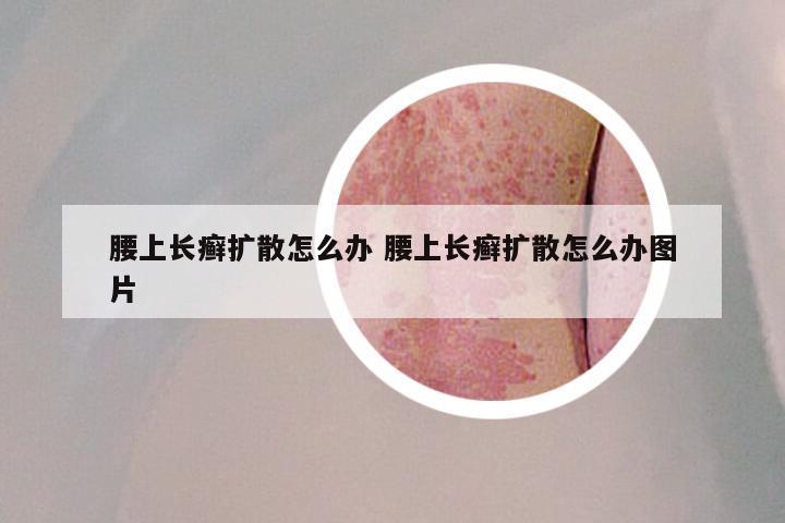 腰上长癣扩散怎么办 腰上长癣扩散怎么办图片