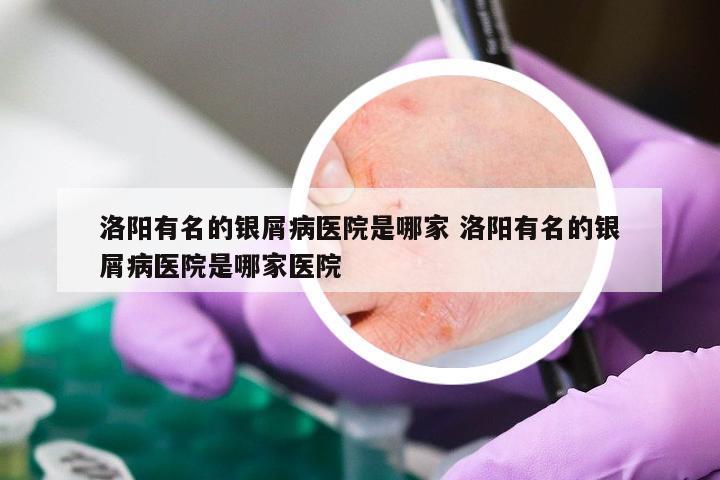 洛阳有名的银屑病医院是哪家 洛阳有名的银屑病医院是哪家医院