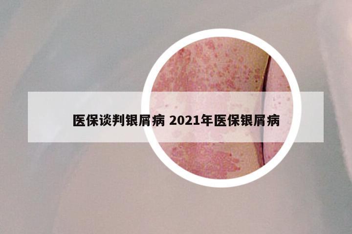 医保谈判银屑病 2021年医保银屑病