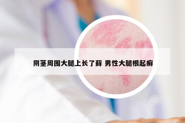 阴茎周围大腿上长了藓 男性大腿根起癣