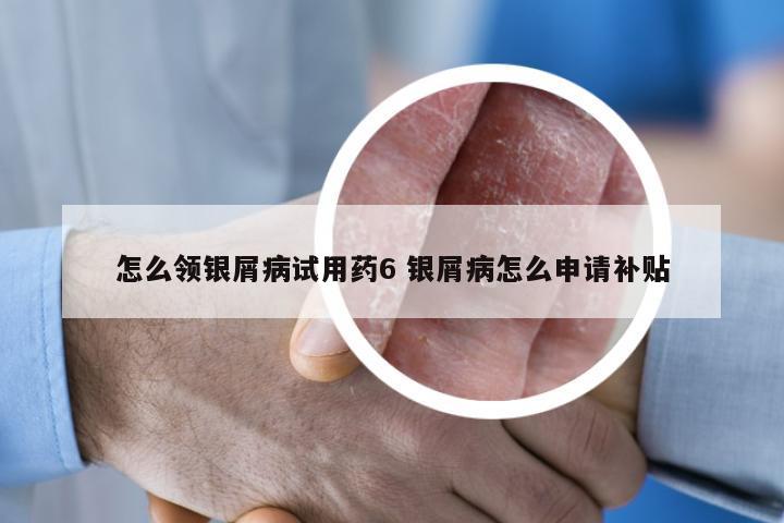 怎么领银屑病试用药6 银屑病怎么申请补贴