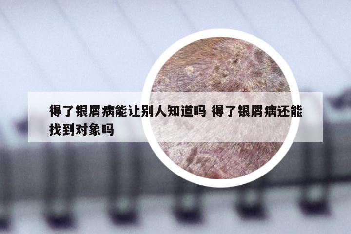 得了银屑病能让别人知道吗 得了银屑病还能找到对象吗