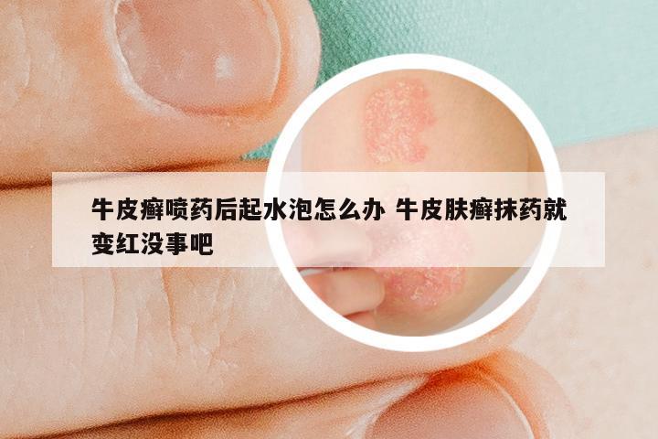 牛皮癣喷药后起水泡怎么办 牛皮肤癣抹药就变红没事吧