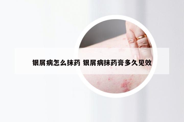 银屑病怎么抹药 银屑病抹药膏多久见效