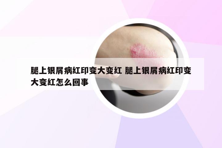 腿上银屑病红印变大变红 腿上银屑病红印变大变红怎么回事