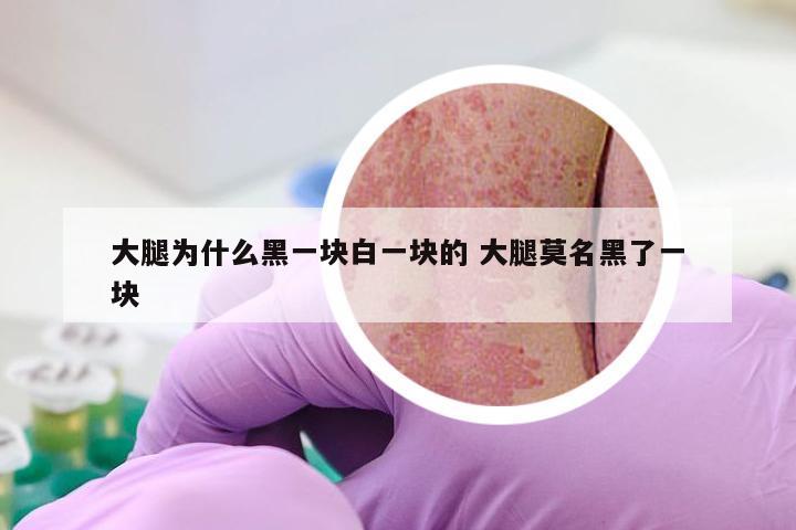 大腿为什么黑一块白一块的 大腿莫名黑了一块