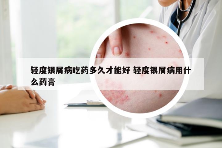 轻度银屑病吃药多久才能好 轻度银屑病用什么药膏