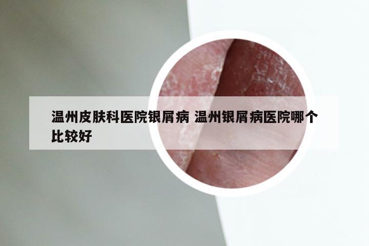 温州皮肤科医院银屑病 温州银屑病医院哪个比较好