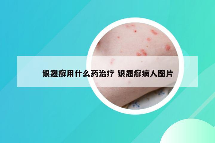 银翘癣用什么药治疗 银翘癣病人图片