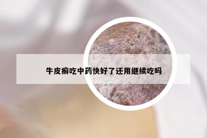 牛皮癣吃中药快好了还用继续吃吗