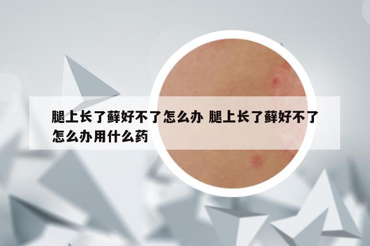 腿上长了藓好不了怎么办 腿上长了藓好不了怎么办用什么药