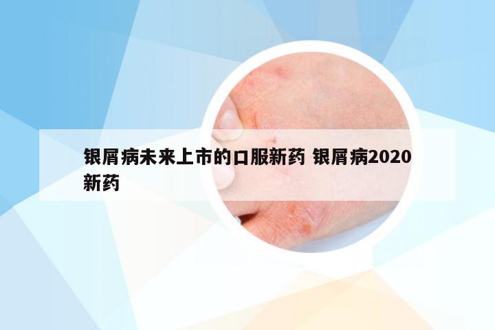 银屑病未来上市的口服新药 银屑病2020新药