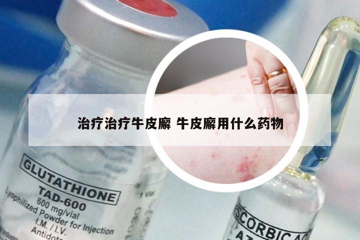 治疗治疗牛皮廨 牛皮廨用什么药物