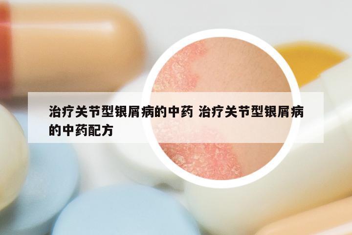 治疗关节型银屑病的中药 治疗关节型银屑病的中药配方