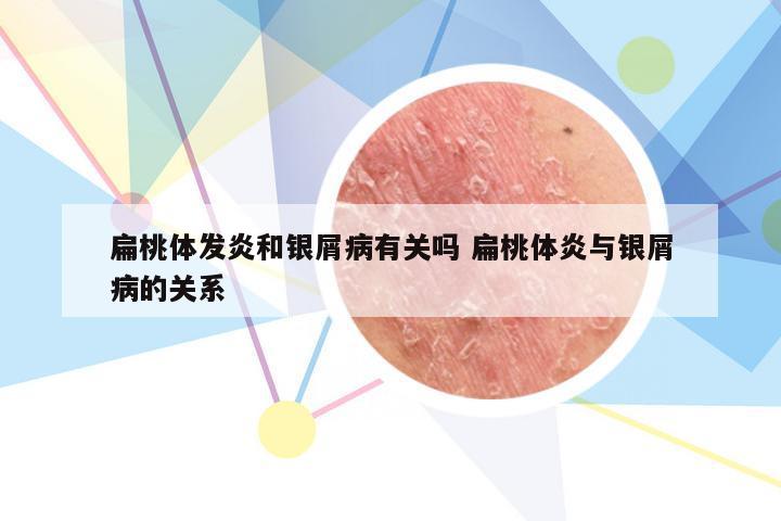 扁桃体发炎和银屑病有关吗 扁桃体炎与银屑病的关系