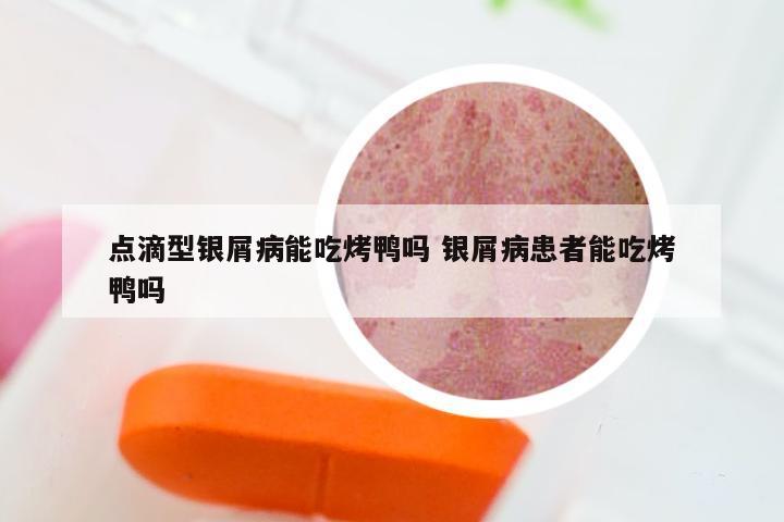 点滴型银屑病能吃烤鸭吗 银屑病患者能吃烤鸭吗