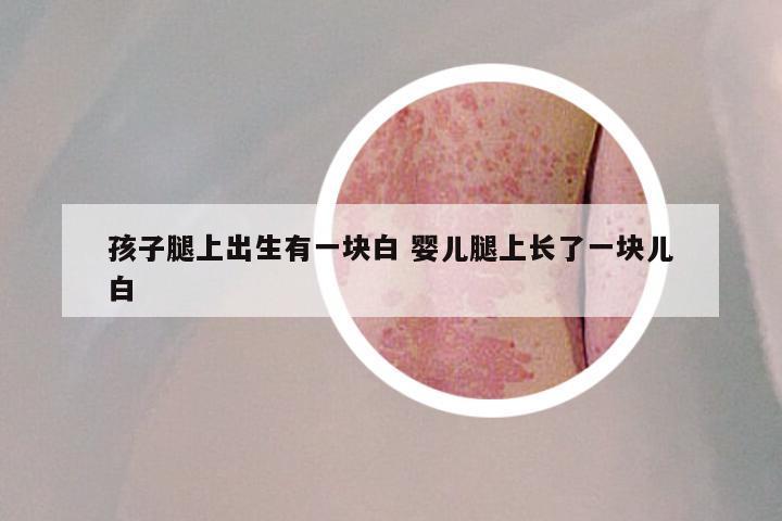 孩子腿上出生有一块白 婴儿腿上长了一块儿白