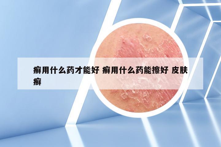 癣用什么药才能好 癣用什么药能擦好 皮肤癣