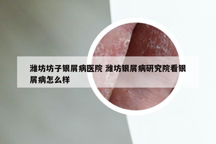 潍坊坊子银屑病医院 潍坊银屑病研究院看银屑病怎么样