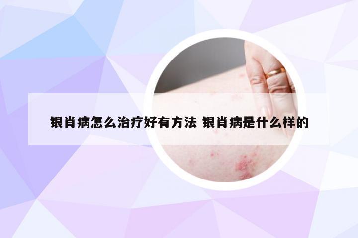 银肖病怎么治疗好有方法 银肖病是什么样的