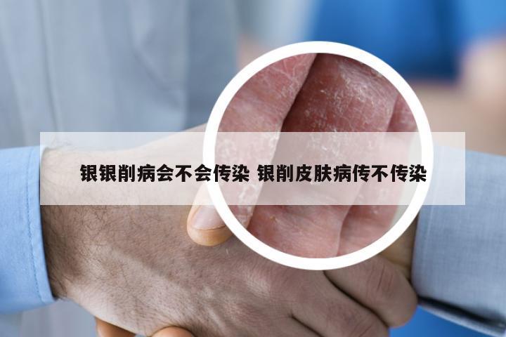 银银削病会不会传染 银削皮肤病传不传染