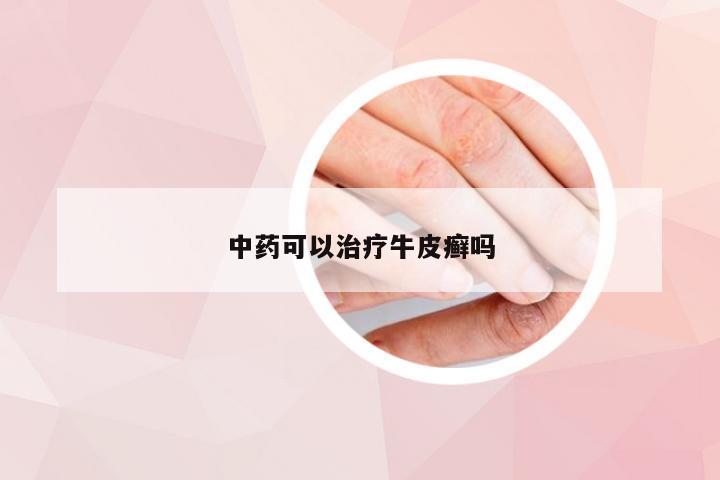 中药可以治疗牛皮癣吗