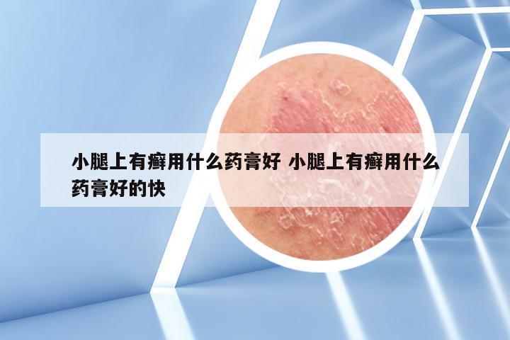 小腿上有癣用什么药膏好 小腿上有癣用什么药膏好的快