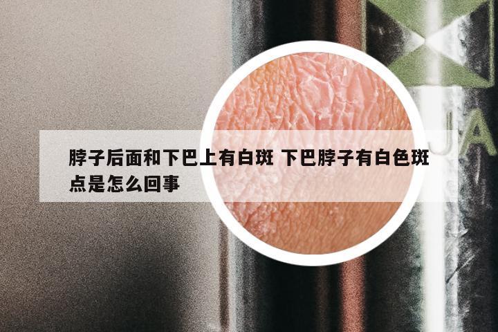 脖子后面和下巴上有白斑 下巴脖子有白色斑点是怎么回事