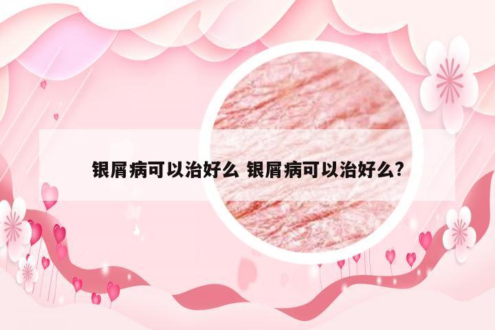 银屑病可以治好么 银屑病可以治好么?