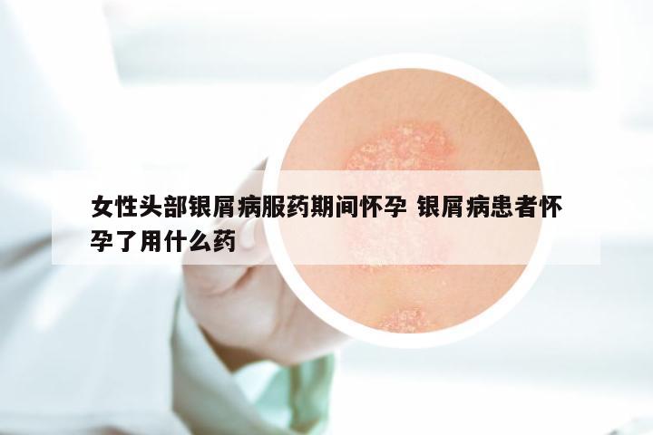 女性头部银屑病服药期间怀孕 银屑病患者怀孕了用什么药