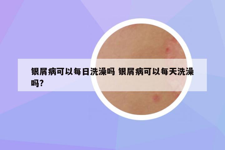 银屑病可以每日洗澡吗 银屑病可以每天洗澡吗?