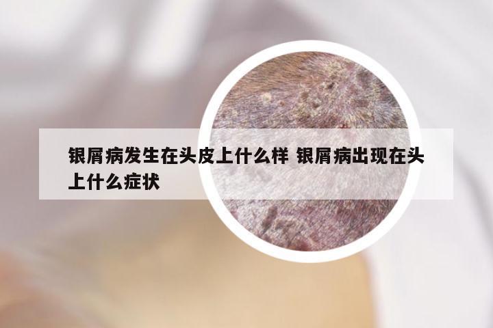 银屑病发生在头皮上什么样 银屑病出现在头上什么症状