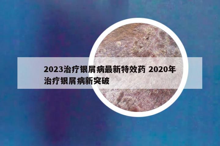 2023治疗银屑病最新特效药 2020年治疗银屑病新突破