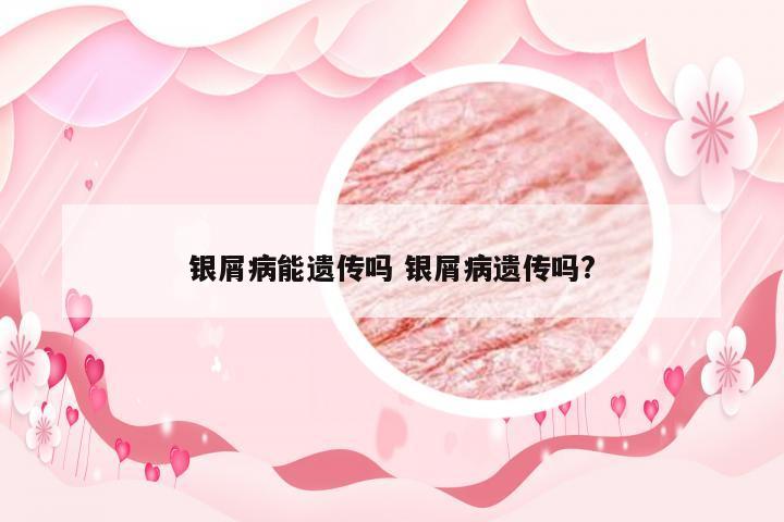 银屑病能遗传吗 银屑病遗传吗?