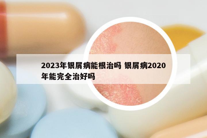 2023年银屑病能根治吗 银屑病2020年能完全治好吗