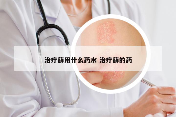 治疗藓用什么药水 治疗藓的药