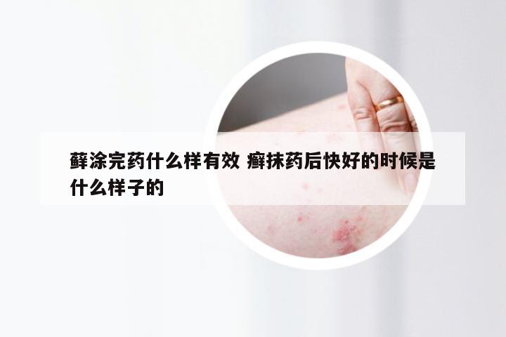 藓涂完药什么样有效 癣抹药后快好的时候是什么样子的