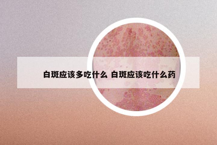 白斑应该多吃什么 白斑应该吃什么药