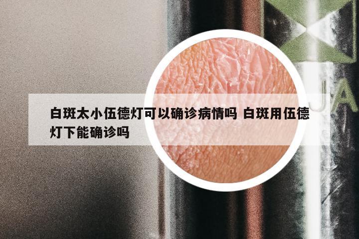 白斑太小伍德灯可以确诊病情吗 白斑用伍德灯下能确诊吗