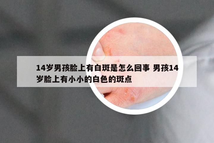 14岁男孩脸上有白斑是怎么回事 男孩14岁脸上有小小的白色的斑点