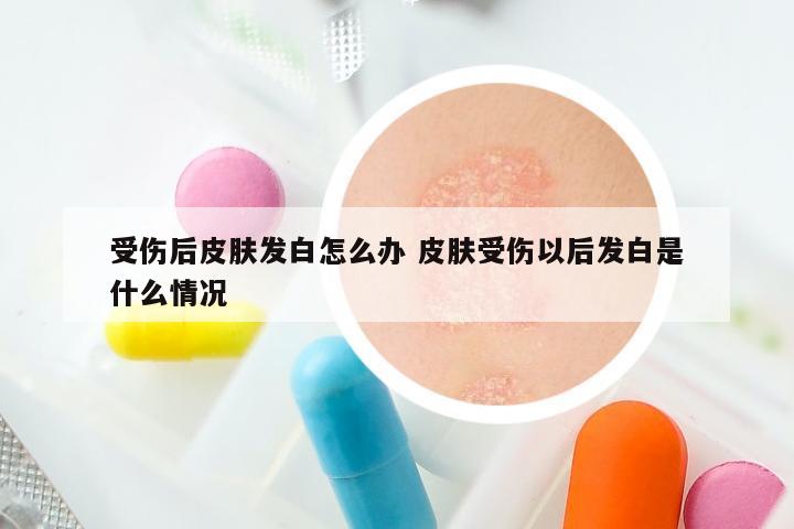 受伤后皮肤发白怎么办 皮肤受伤以后发白是什么情况