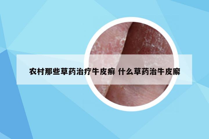 农村那些草药治疗牛皮癣 什么草药治牛皮廨