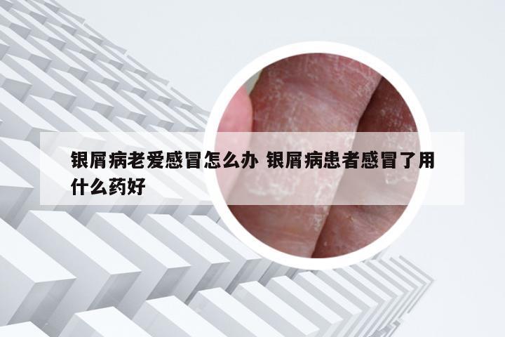 银屑病老爱感冒怎么办 银屑病患者感冒了用什么药好