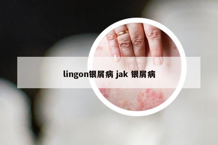 lingon银屑病 jak 银屑病