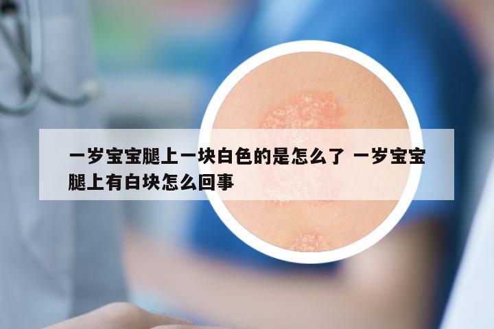 一岁宝宝腿上一块白色的是怎么了 一岁宝宝腿上有白块怎么回事