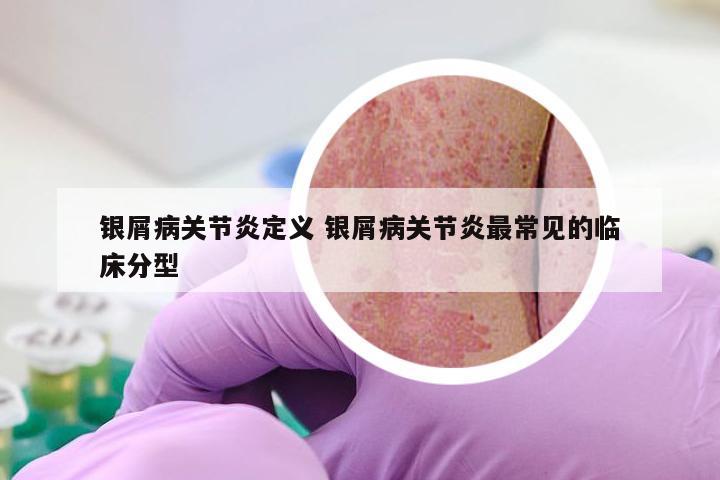 银屑病关节炎定义 银屑病关节炎最常见的临床分型