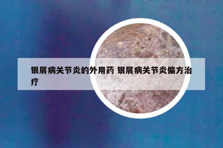 银屑病关节炎的外用药 银屑病关节炎偏方治疗