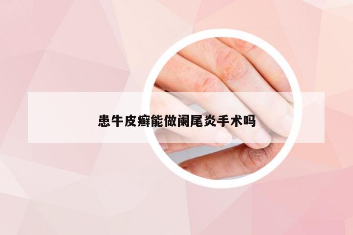 患牛皮癣能做阑尾炎手术吗