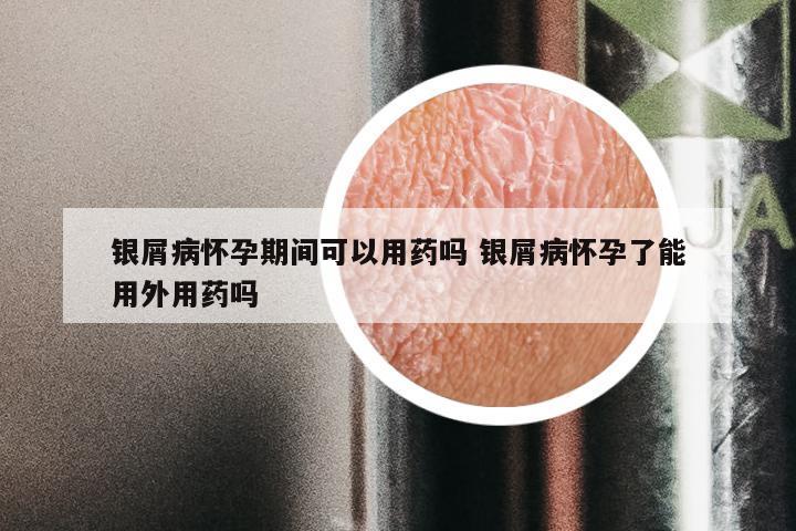 银屑病怀孕期间可以用药吗 银屑病怀孕了能用外用药吗